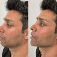 آموزش کاشت مو فیلر ژل بوتاکس نخ لیفت لیزر مو فشیال|خدمات آموزشی|اصفهان, ملک‌شهر|دیوار