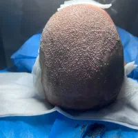 کاشت مو تخصصی|خدمات آرایشگری و زیبایی|پارس‌آباد, |دیوار