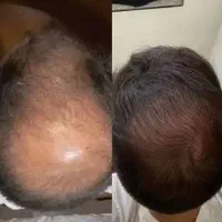 خداحافظی با ریزش مو در یک دوره ۱۰۰٪ گیاهی و تضمینی