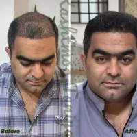 کاشت مو تیم کادر درمان شیرازی در یزد تراکم بالا