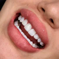 ایمپلنت کره ای و آلمانی باوام یکساله بانکی