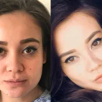 بلفاروپلاستی/جراحی پلک/مدل گربه/سانترال/بوکال