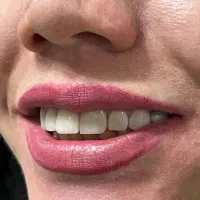 تخفیفات وشرایط اقساطی برای ایمپلنت و پروتز مصنوعی