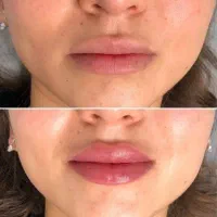 تخفیف ویژه روی کلیه کارهای زیبایی فیلر و بوتاکس|خدمات آرایشگری و زیبایی|شیراز, تاچارا|دیوار
