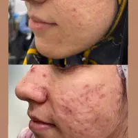 به مدل جهت انجام تکنیک آیینه سازی پوست|خدمات آرایشگری و زیبایی|ورامین, ورامین|دیوار