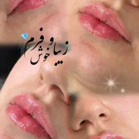 تزریق فیلر وبوتاکس وجوانساز صورت|خدمات آرایشگری و زیبایی|کارون, |دیوار