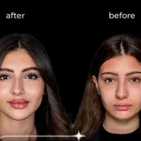 تخفیف فیلر چهره بانوان هر سی سی 950
