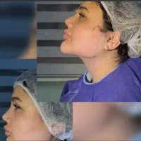 دکتر متخصص لیپو غبغب