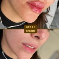 ژل لب بوتاکس زیر بغل فیلر بادی لیفت شقیقه نخ لیفت|خدمات آرایشگری و زیبایی|اصفهان, فیض|دیوار