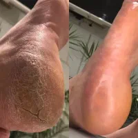 کرم‌ ترک پا تضمینی