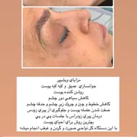 جوانسازی پوست و لیفت صورت|خدمات آرایشگری و زیبایی|تهران, زعفرانیه|دیوار