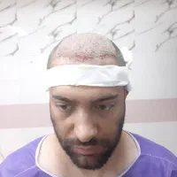 بلفاروپلاستی ،سانترال،دایرکت ابرو،کاشت vipجشنواره|خدمات آرایشگری و زیبایی|تهران, تجریش|دیوار