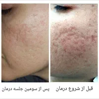 **درمان تخصصی و تضمینی اسکار آکنه**