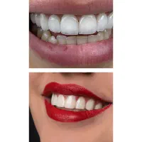 ایمپلنت، لمینت، کامپوزیت، اقساطی، معاینه رایگان