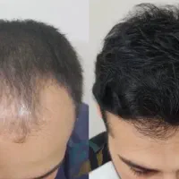 طاسی رو برطرف کن