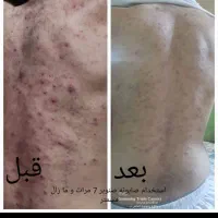 درمان جوش بدن