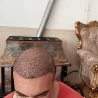 کاشت مو و ابرو در میانه|خدمات آرایشگری و زیبایی|میانه, |دیوار