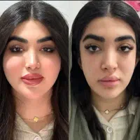 چربی،ژل،بوتاکس،پی آرپی ،بلفاروپلاستی و دایرکت ابرو