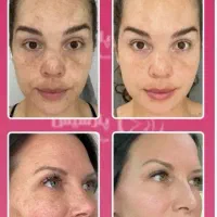 هایفوتراپی و آر اف ۷بعدی اولترا|خدمات آرایشگری و زیبایی|قم, زینبیه|دیوار