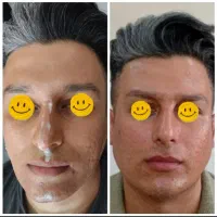 بوتاکس وفیلر صورت