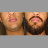 ریشاتو ریشه ای پرپشت کن