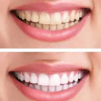 پودر سفید کننده دندان