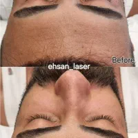لیزر و فیشال آقایان تیتانیوم پلاس وکندلا2025|خدمات آرایشگری و زیبایی|شیراز, فرهنگ شهر|دیوار