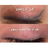 ریموو(پاک کردن تاتو) صورت وبدن با لیزر پیشرفته