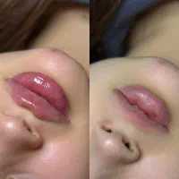 فیلر و بوتاکس ارومیه
