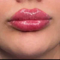 تزریق ژل بوتاکس تمام خدمات تخفیف شب یلدایی