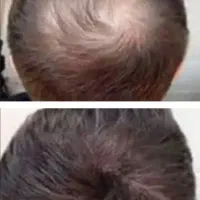 معجون پر پشتی کف سر