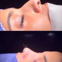 جراحی بینی با تخفیف استثنایی به مدت ۱۰روز|خدمات آرایشگری و زیبایی|بندرعباس, |دیوار