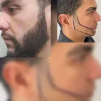 کاشت مو دکترسسلیمی