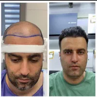 جشنواره فوق العاده کاشت مو ، ریش و ابرو