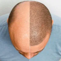 کاشت مو تخصصی با تخفیف و شرایط ویژه