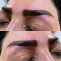 فیبروز تزریق ژل بوتاکس پی آر پی پیرسینگ و...