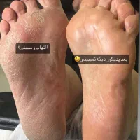 پدیکور و رفع کامل ترک پا تخفیف ویژه