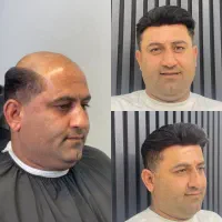 خدمات پروتز مو در بابل