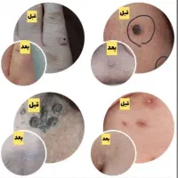 درمان Hpv و زگیل