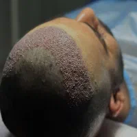 کاشت مو و ابرو|خدمات آرایشگری و زیبایی|میانه, |دیوار