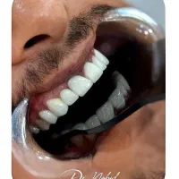 دندانپزشکی/کامپوزیت دیجیتال/ ایمپلنت/عصب کشی|خدمات آرایشگری و زیبایی|مشهد, ده دی|دیوار