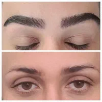 کاشت ابرو و مو با تیم متخصص