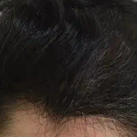 میکرواسکالپ و پرپشتی موی سر مدل