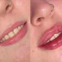 جشنواره پاییزه تزریق ژل بوتاکس مزوژل درکلینیک پزشک