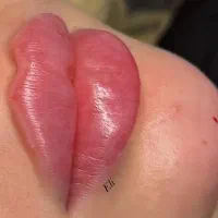 ژل لب چونه گونه زاویه فک و بوتاکس ۳۹۹ تا آخر هفته