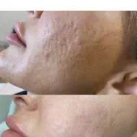 مزوتراپی جوانساز و پی آرپی مو وصورت