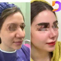 عمل بینی اقساط با سفته با دکتر پلاس