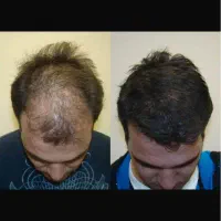 درمان ریشه ای مشکلات مو‌  با ضمانت عودت وجه|خدمات آرایشگری و زیبایی|قزوین, |دیوار
