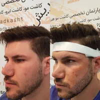 کاشت مو،کاشت ابرو،کاشت ریش با شرایط استثنایی|خدمات آرایشگری و زیبایی|تهران, دردشت|دیوار