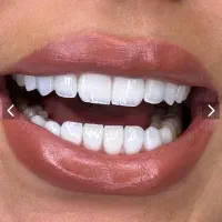 کامپوزیت دندان فکی 7 میلیون